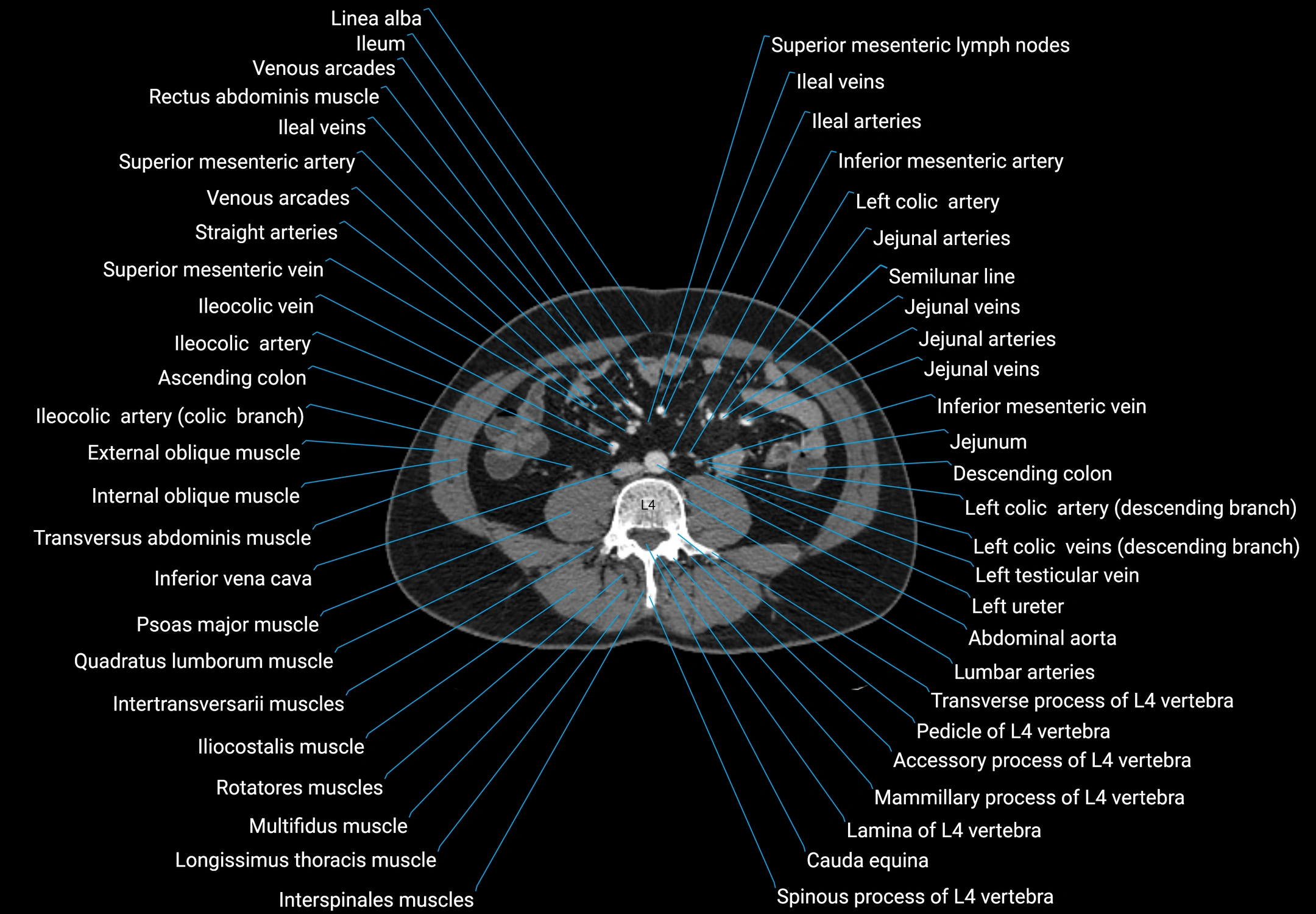 CT male pelvis axial cross sectional anatomy labelled radiology image -00108.webp